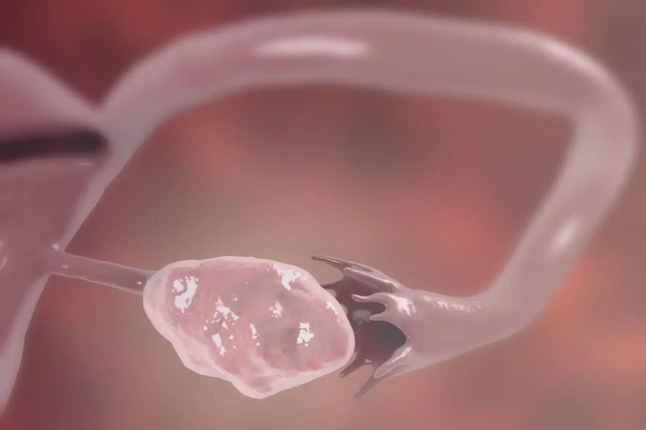Trompes bouchée (infertilité tubaire) | Trompes bouchées symptômes | Clinique de la fertilité | Paris